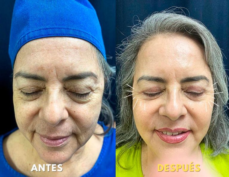 Blefaroplastia Laser