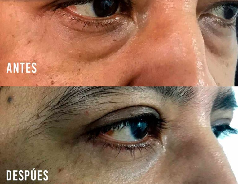 Blefaroplastia Laser