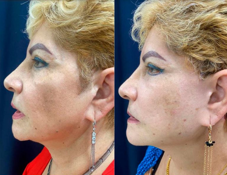 lifting_cervico_facial_laser_manta_manabi_02
