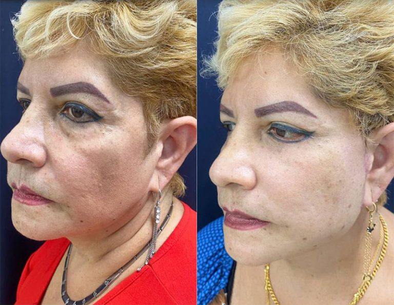 Lifting Cervico Facial Laser