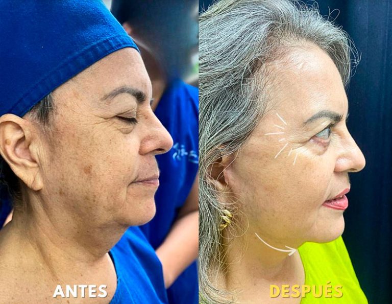 Lifting Facial Laser Blefaroplastia