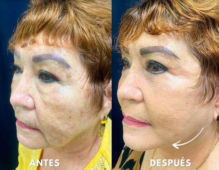 Lifting Facial Laser Blefaroplastia
