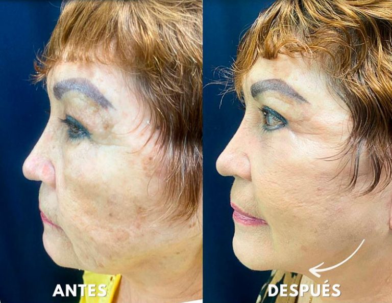 lifting_facial_laser_blefaroplastia_manta_manabi_03