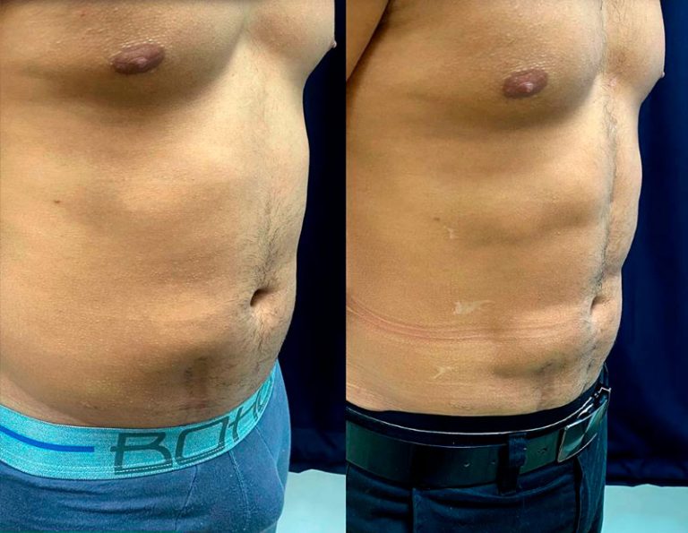 lipoescultura_manta_manabi_01