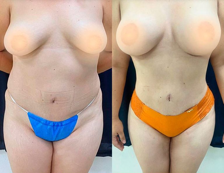 lipoescultura_manta_manabi_04