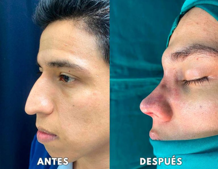 Septo Rinoplastia