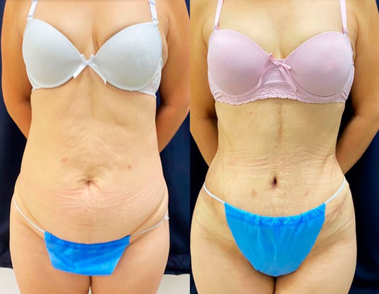 Abdominoplastia