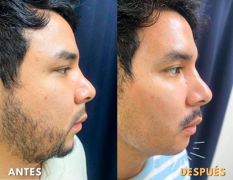 Mentoplastia con implante