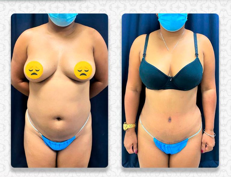 Abdominoplastia (40 días)