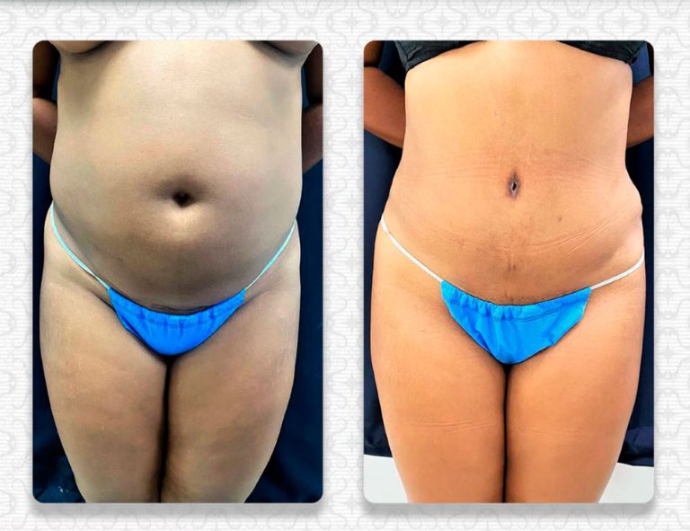 Abdominoplastia (40 días)