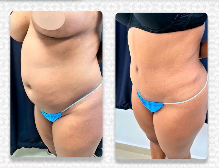 Abdominoplastia (40 días)