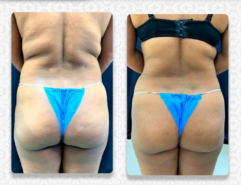 Abdominoplastia (40 días)