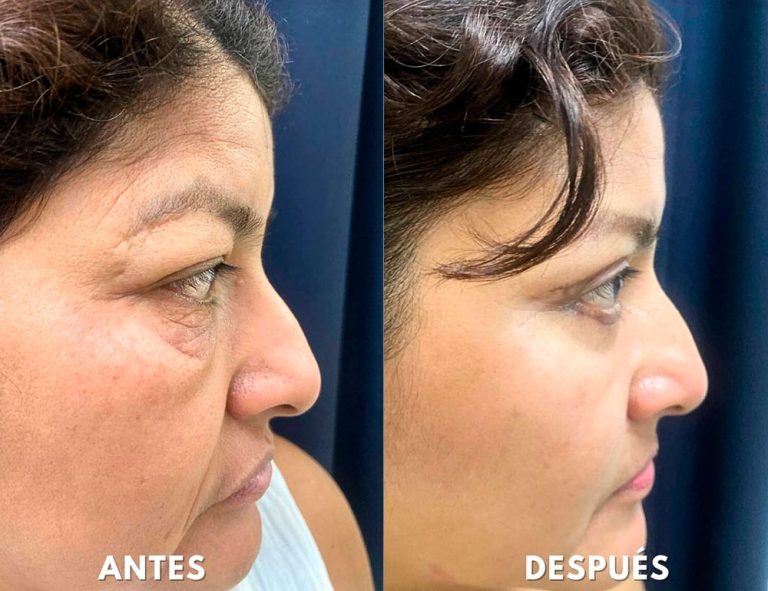 Blefaroplastia Láser. Post-operatorio (40 días)