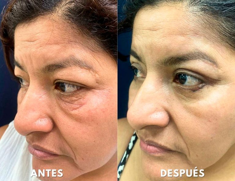Blefaroplastia Láser. Post-operatorio (40 días)