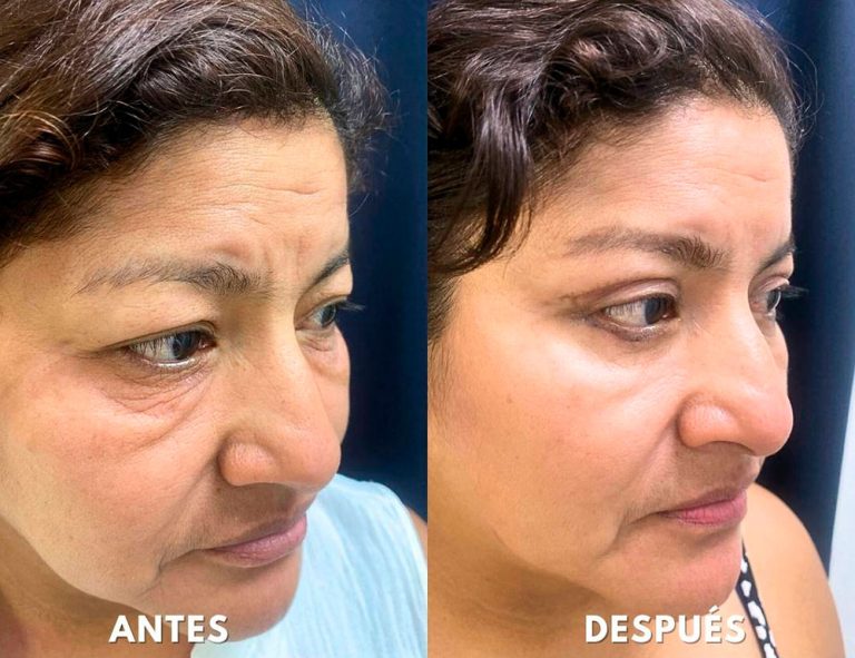 Blefaroplastia Láser. Post-operatorio (40 días)