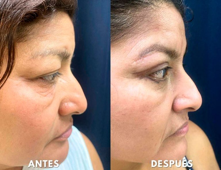 Blefaroplastia Láser. Post-operatorio (40 días)