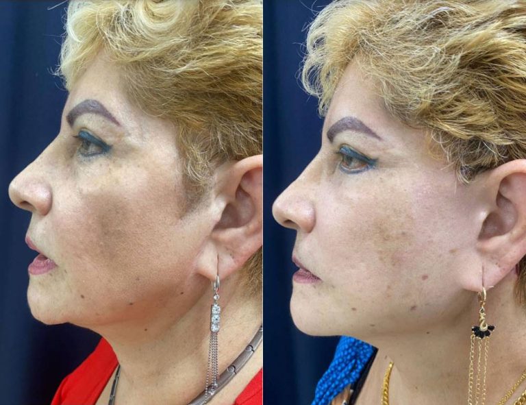 Lifting Facial. Perfilado (cara y cuello)