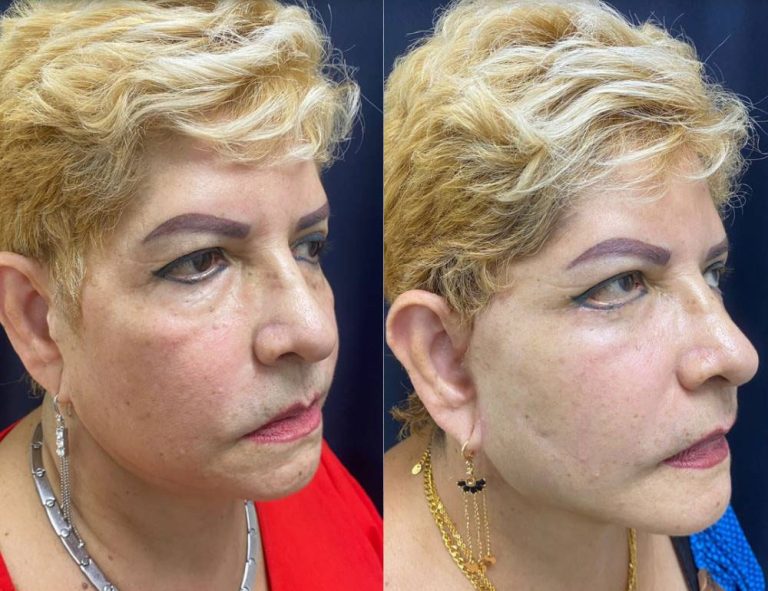 Lifting Facial. Perfilado (cara y cuello)