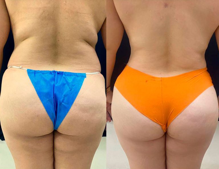 Post-operatorio (6 meses)