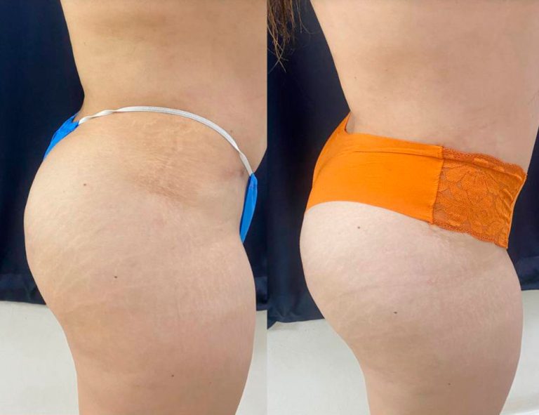 Post-operatorio (6 meses)