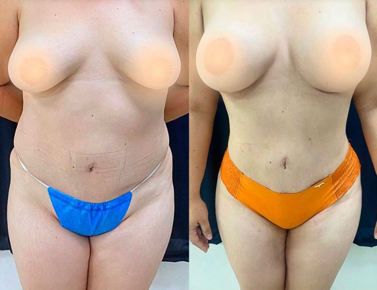 Post-operatorio (6 meses)