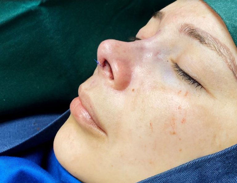 Rinoplastia (post-op)