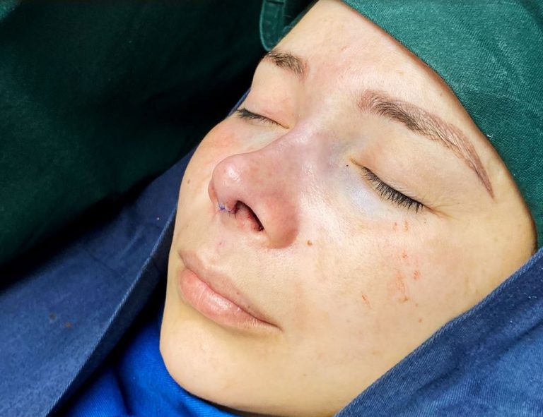 Rinoplastia (post-op)