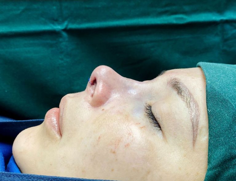 Rinoplastia (post-op)