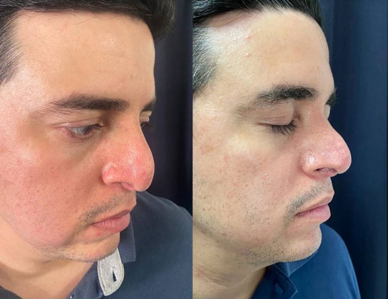 Rinoplastia secundaria