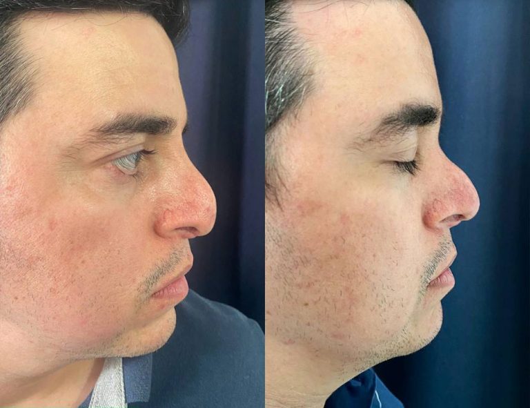 Rinoplastia secundaria