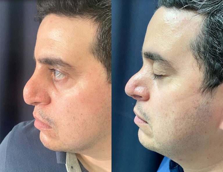 Rinoplastia secundaria