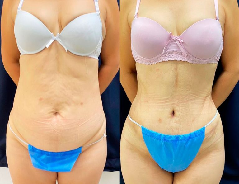 Abdominoplastia (40 días)