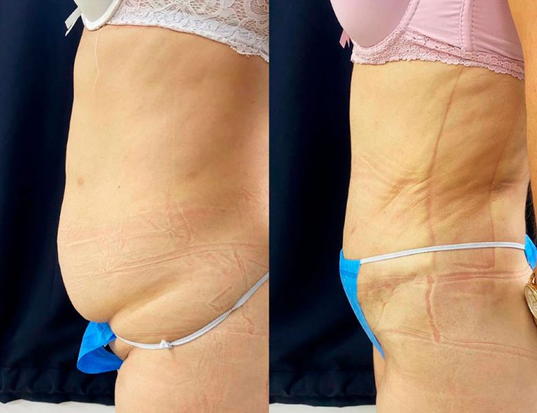 Abdominoplastia (40 días)