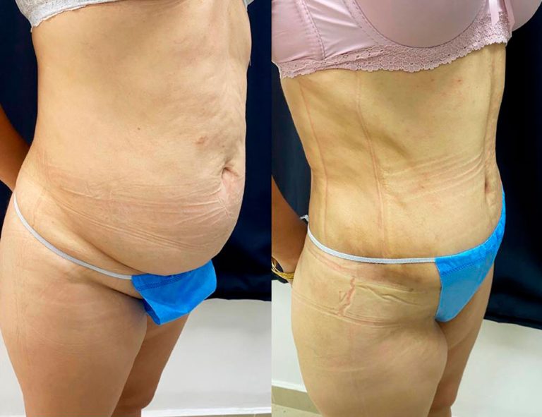 Abdominoplastia (40 días)