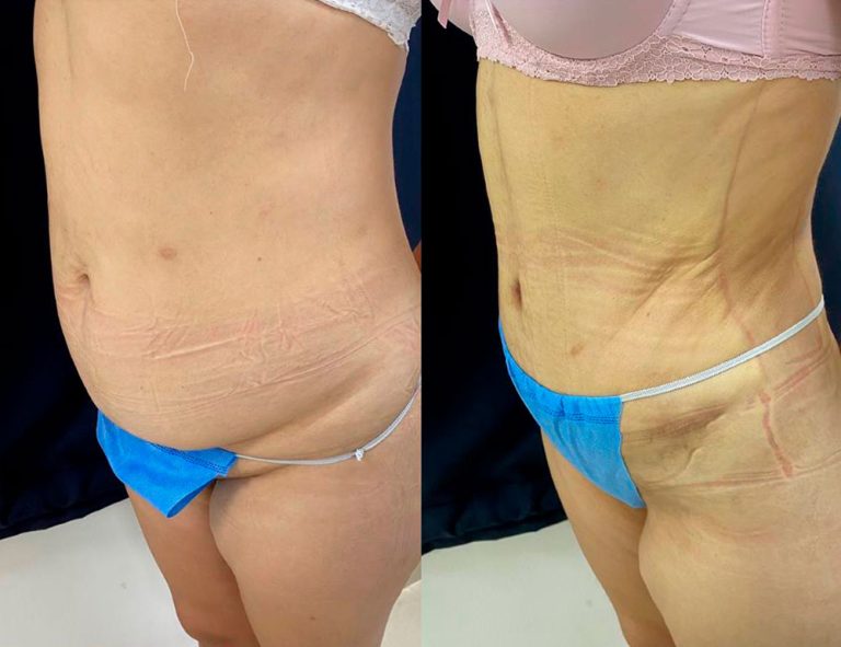 Abdominoplastia (40 días)