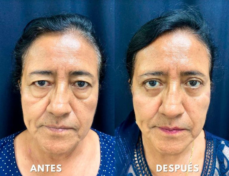 Blefaroplastia Láser. Post-operatorio (40 días)