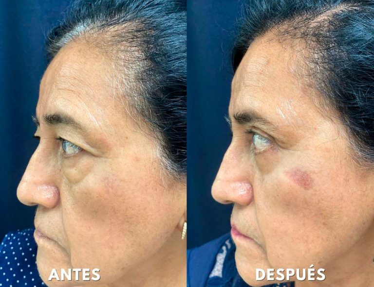 Blefaroplastia Láser. Post-operatorio (40 días)