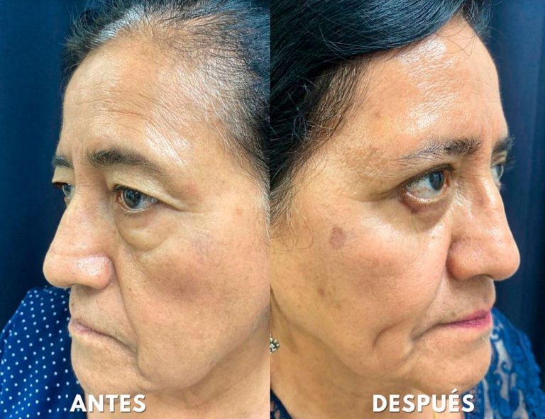 Blefaroplastia Láser. Post-operatorio (40 días)