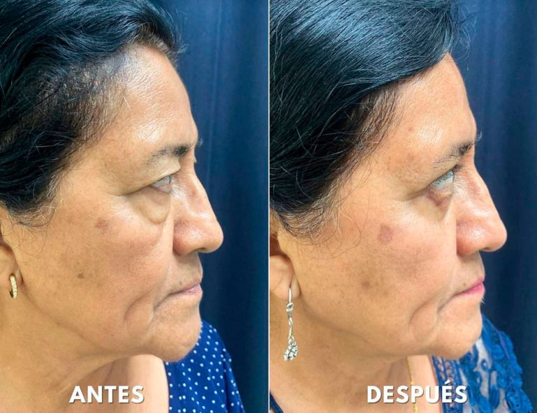 Blefaroplastia Láser. Post-operatorio (40 días)