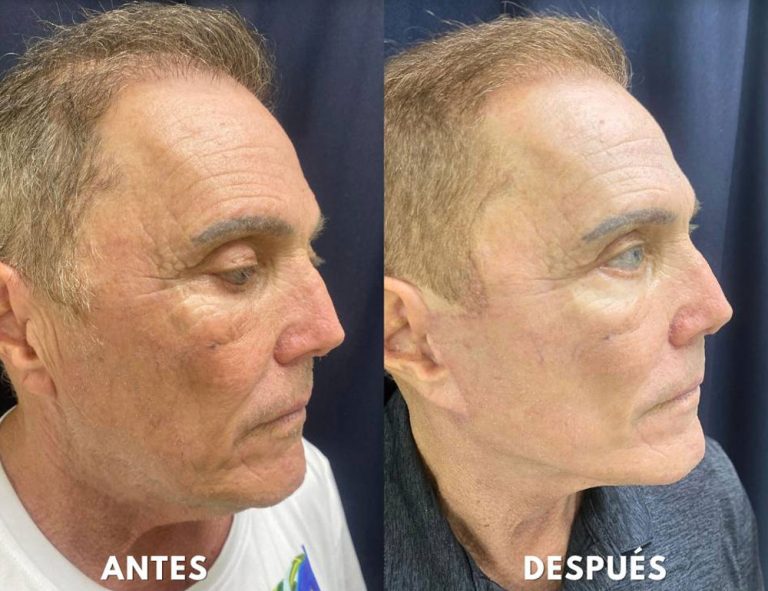 Rejuvenecimiento cérvico facial (40 días post operatorio)