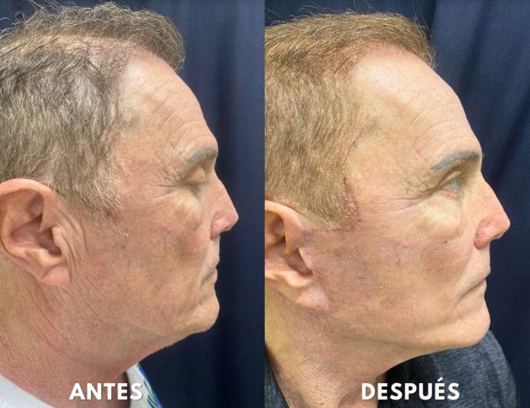 Rejuvenecimiento cérvico facial (40 días post operatorio)