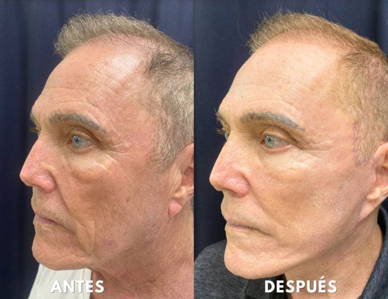 Rejuvenecimiento cérvico facial (40 días post operatorio)