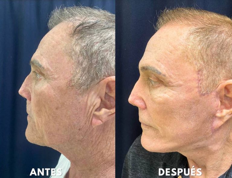 Rejuvenecimiento cérvico facial (40 días post operatorio)