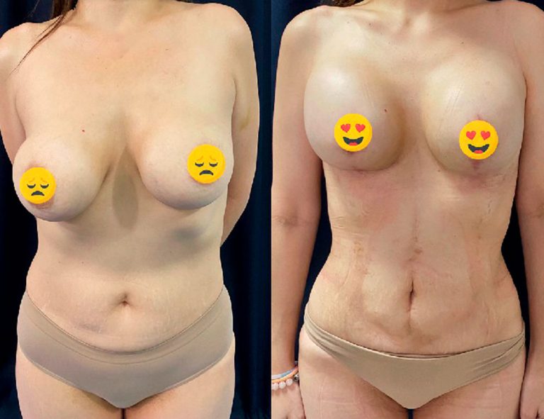 Lipoescultura y mamas