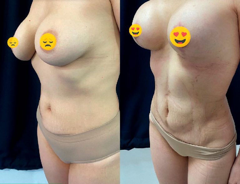 Lipoescultura y mamas