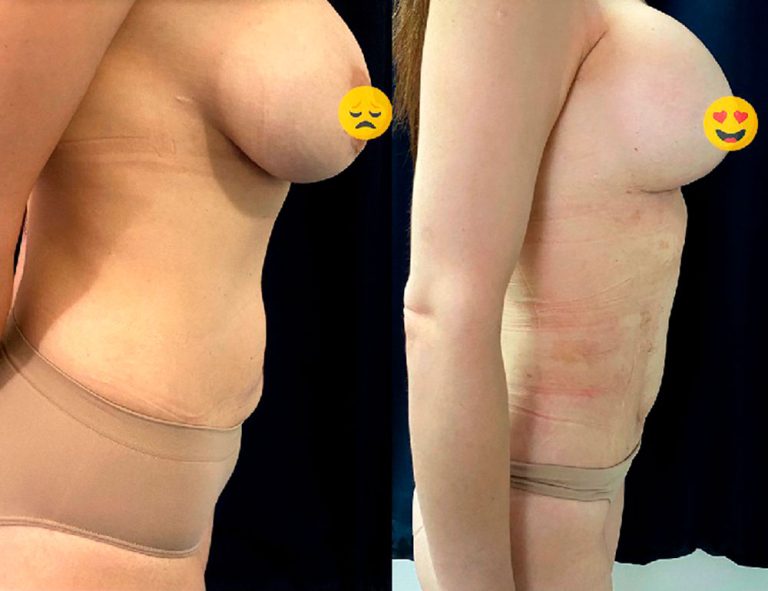 Lipoescultura y mamas