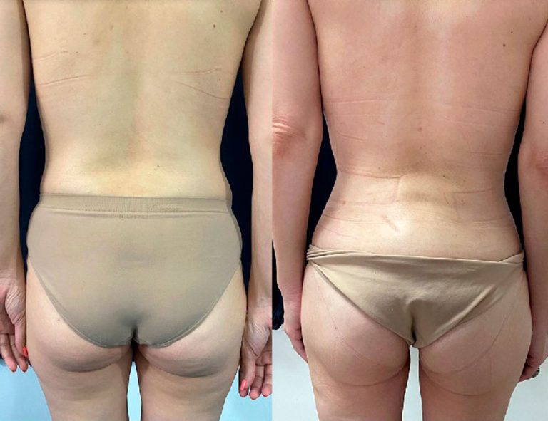 Lipoescultura y mamas