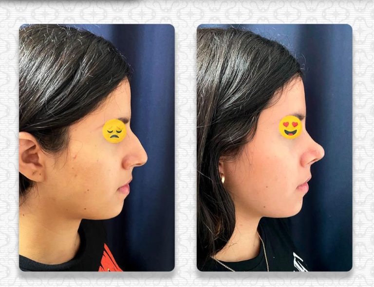 Rinoplastia (1 mes)