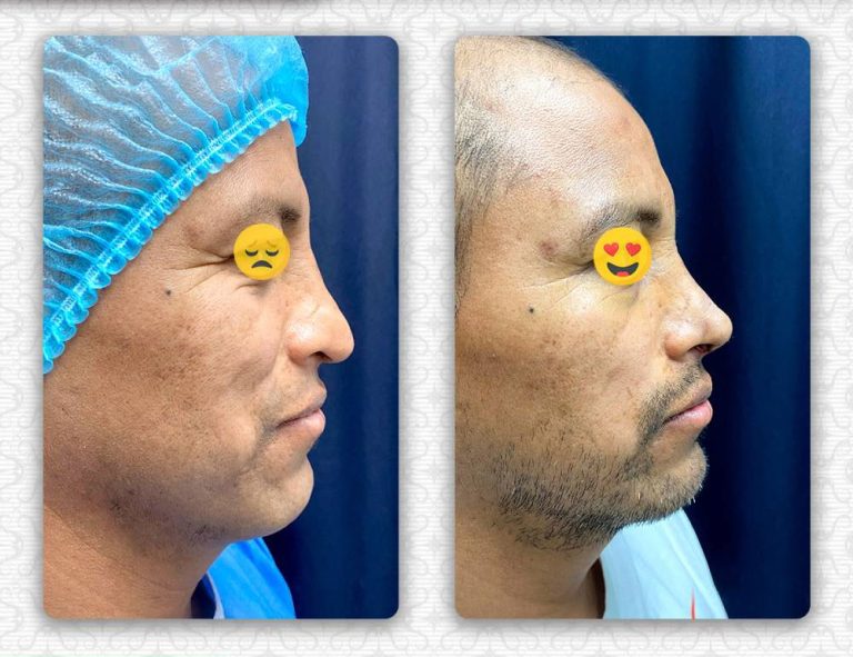 Rinoplastia secundaria