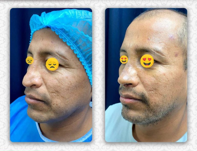 Rinoplastia secundaria